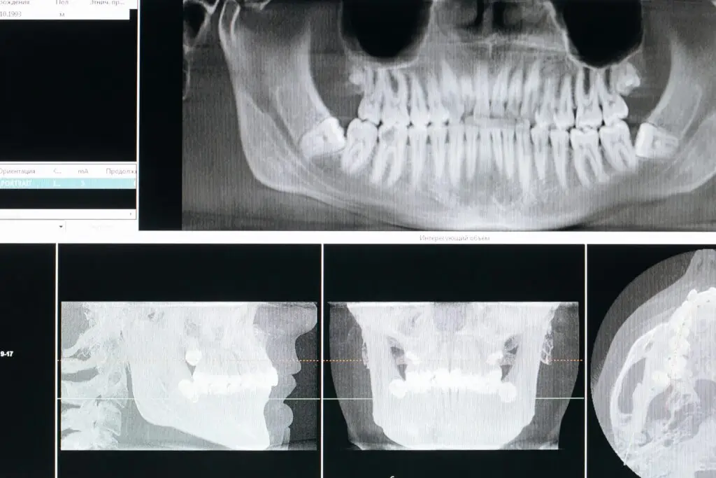 Image on top is a full panoramic image of both maxillary and mandibular jaws. Below is a CBCT image of the side and facial view.